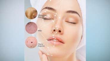 Removal Skin Irregularities
